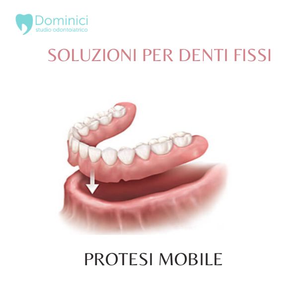 PROTESI MOBILE